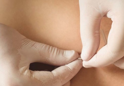 Unlocking Pain Relief: How A Dry Needling Clinic In Las Vegas Complements Osteopathic Treatments